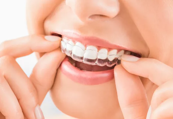 Clear Aligner Orthodontics