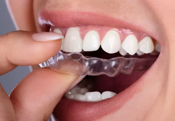 Clear Aligner Therapy (Advanced)